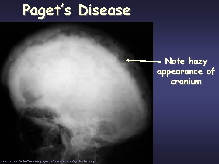 Paget’s Disease Note hazy appearance of cranium http: //www. amershamhealth. com/medcyclopaedia/Volume%20 III%201/Pagets%20 disease. asp