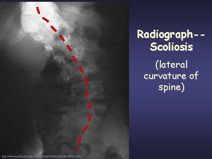 Radiograph-Scoliosis (lateral curvature of spine) http: //www-medlib. med. utah. edu/Web. Path/BONEHTML/BONEIDX. html 