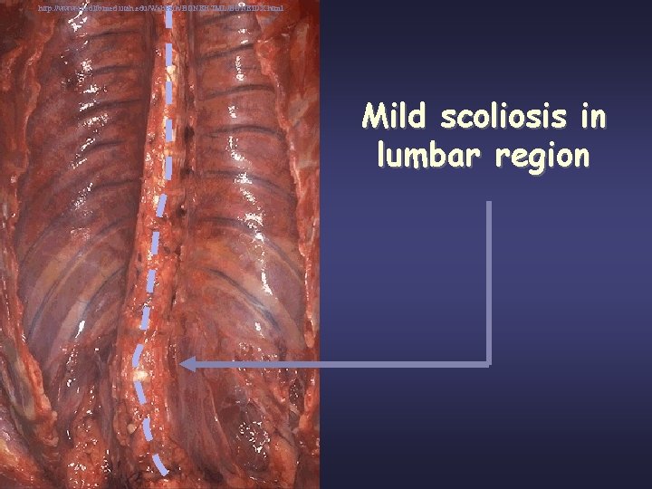 http: //www-medlib. med. utah. edu/Web. Path/BONEHTML/BONEIDX. html Mild scoliosis in lumbar region 