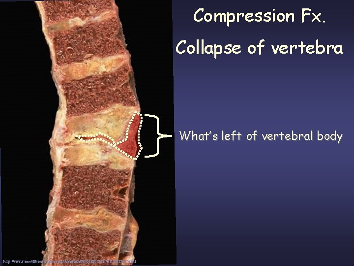 Compression Fx. Collapse of vertebra What’s left of vertebral body http: //www-medlib. med. utah.