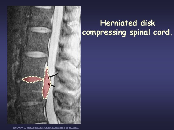 Herniated disk compressing spinal cord. http: //www-medlib. med. utah. edu/Web. Path/BONEHTML/BONEIDX. html 