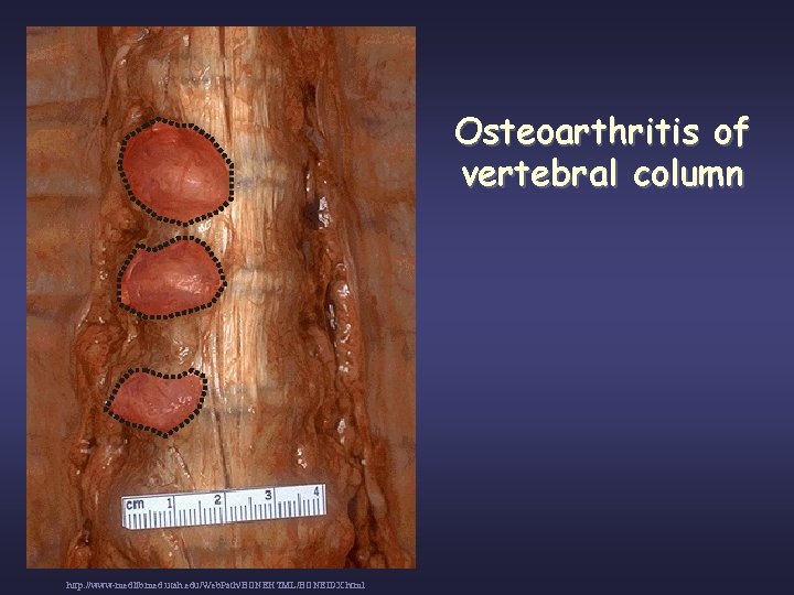 Osteoarthritis of vertebral column http: //www-medlib. med. utah. edu/Web. Path/BONEHTML/BONEIDX. html 