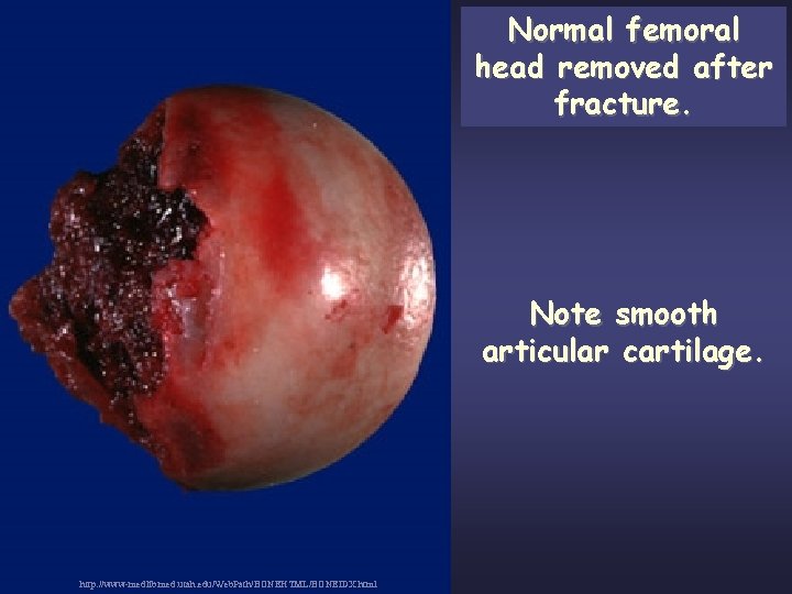 Normal femoral head removed after fracture. Note smooth articular cartilage. http: //www-medlib. med. utah.