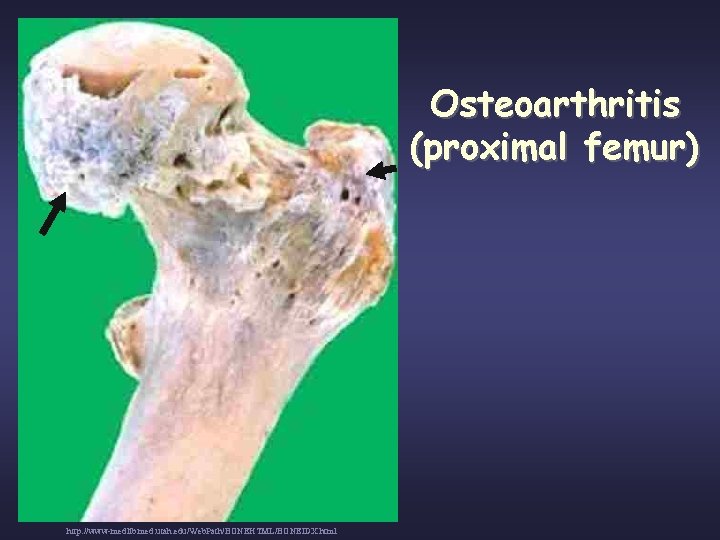 Osteoarthritis (proximal femur) http: //www-medlib. med. utah. edu/Web. Path/BONEHTML/BONEIDX. html 