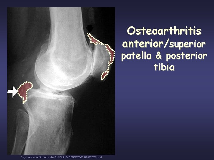 Osteoarthritis anterior/superior patella & posterior tibia http: //www-medlib. med. utah. edu/Web. Path/BONEHTML/BONEIDX. html 