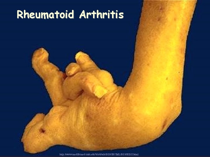 Rheumatoid Arthritis http: //www-medlib. med. utah. edu/Web. Path/BONEHTML/BONEIDX. html 