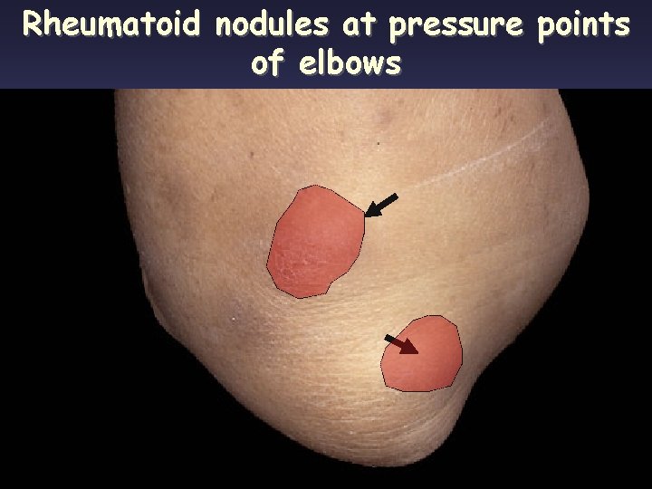 Rheumatoid nodules at pressure points of elbows 