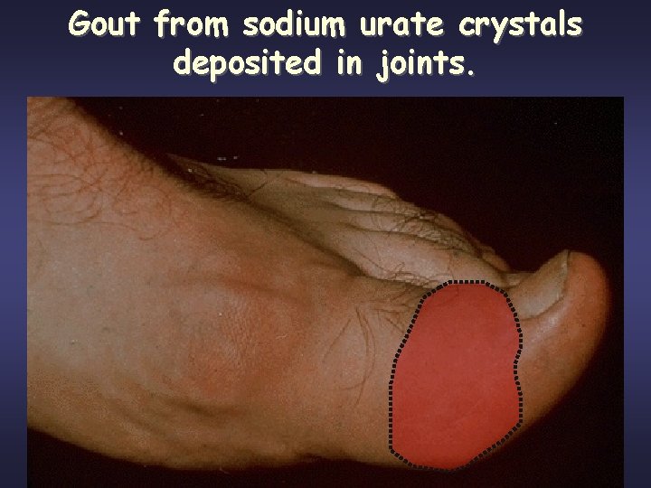 Gout from sodium urate crystals deposited in joints. 