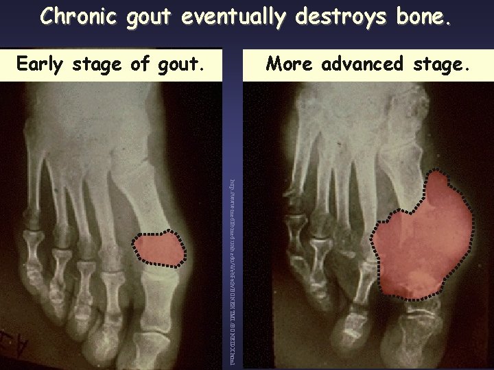 Chronic gout eventually destroys bone. Early stage of gout. More advanced stage. http: //www-medlib.