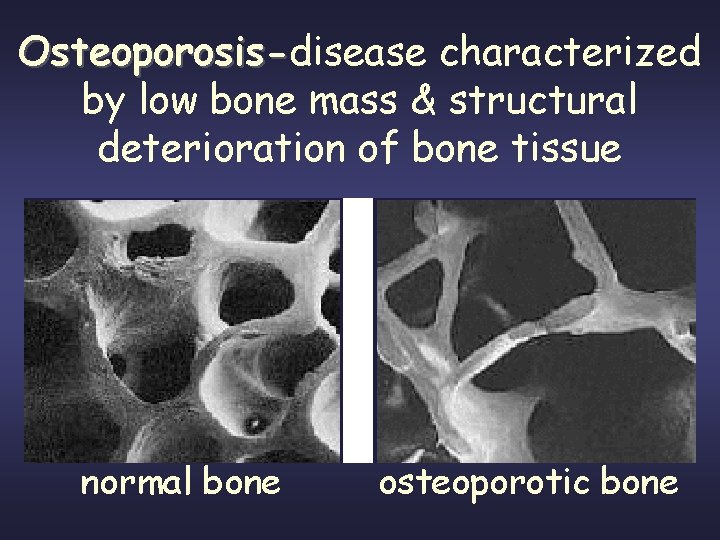 Osteoporosis-disease characterized Osteoporosisby low bone mass & structural deterioration of bone tissue normal bone