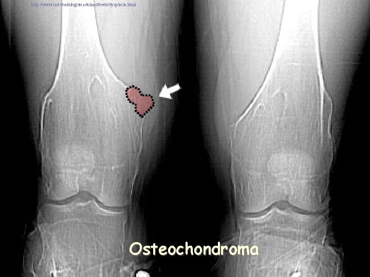 http: //www. rad. washington. edu/mskbook/dysplasia. html Osteochondroma 