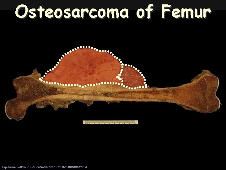 Osteosarcoma of Femur http: //www-medlib. med. utah. edu/Web. Path/BONEHTML/BONEIDX. html 