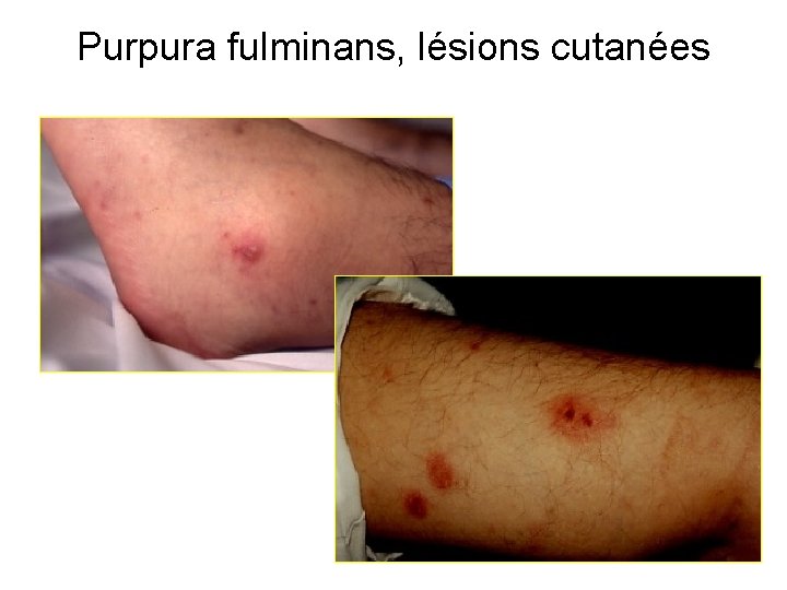 Purpura fulminans, lésions cutanées 