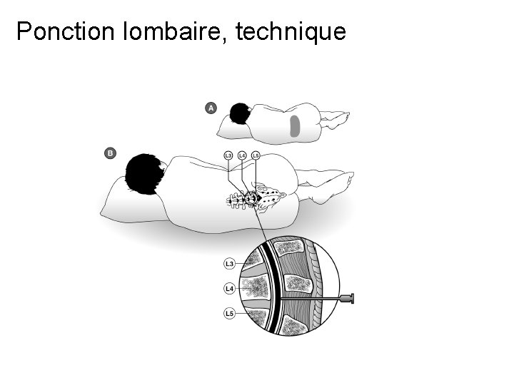 Ponction lombaire, technique 