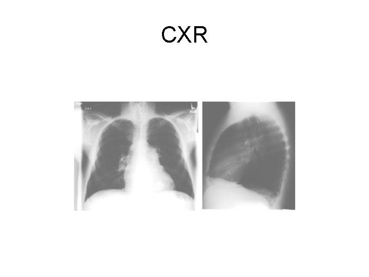 CXR 