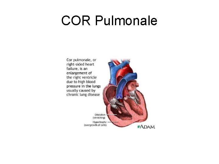 COR Pulmonale 