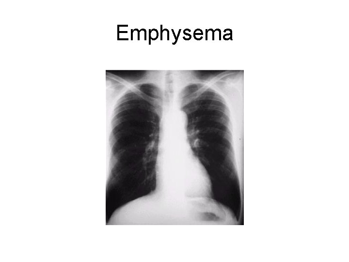 Emphysema 