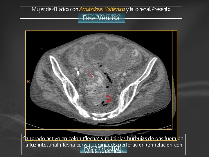 Mujer de 41 años con Amiloidosis Sistémica y fallo renal. Presentó rectorragia masiva Fase