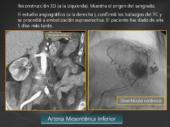 Reconstrucción 3 D (a la izquierda). Muestra el origen del sangrado. El estudio angiográfico