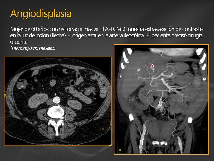Angiodisplasia Mujer de 60 años con rectorragia masiva. El A-TCMD muestra extravasación de contraste