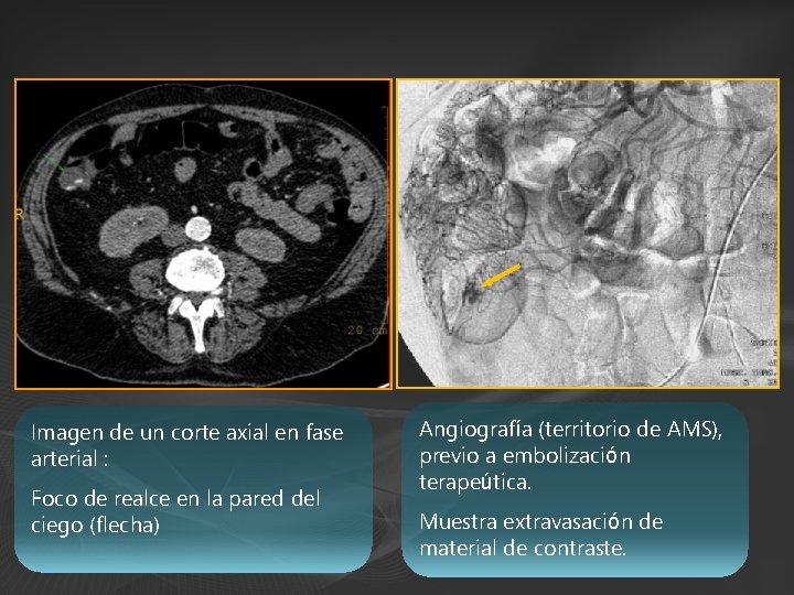 Imagen de un corte axial en fase arterial : Foco de realce en la