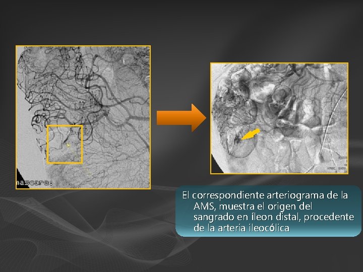 El correspondiente arteriograma de la AMS, muestra el origen del sangrado en íleon distal,