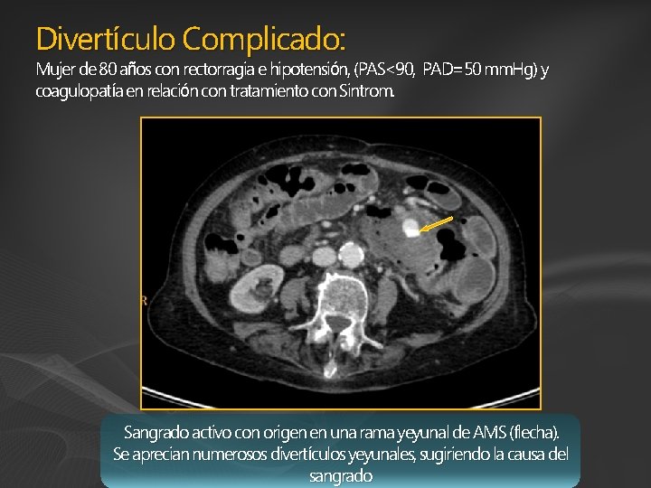 Divertículo Complicado: Mujer de 80 años con rectorragia e hipotensión, (PAS<90, PAD=50 mm. Hg)