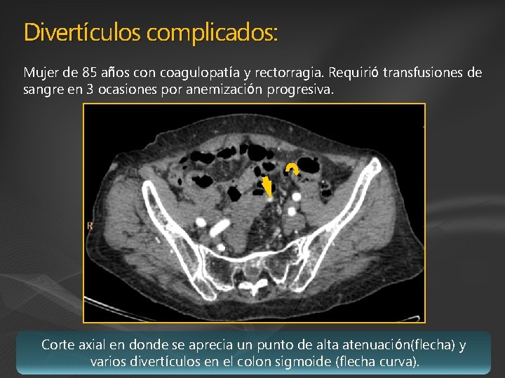 Divertículos complicados: Mujer de 85 años con coagulopatía y rectorragia. Requirió transfusiones de sangre