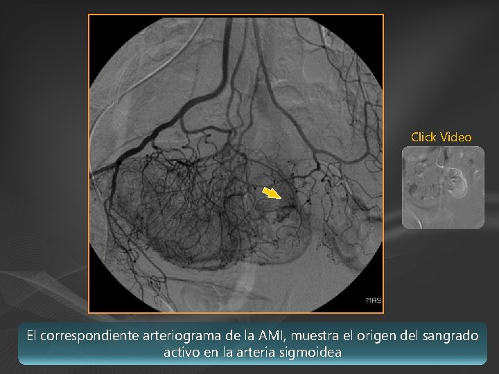 Click Video El correspondiente arteriograma de la AMI, muestra el origen del sangrado activo