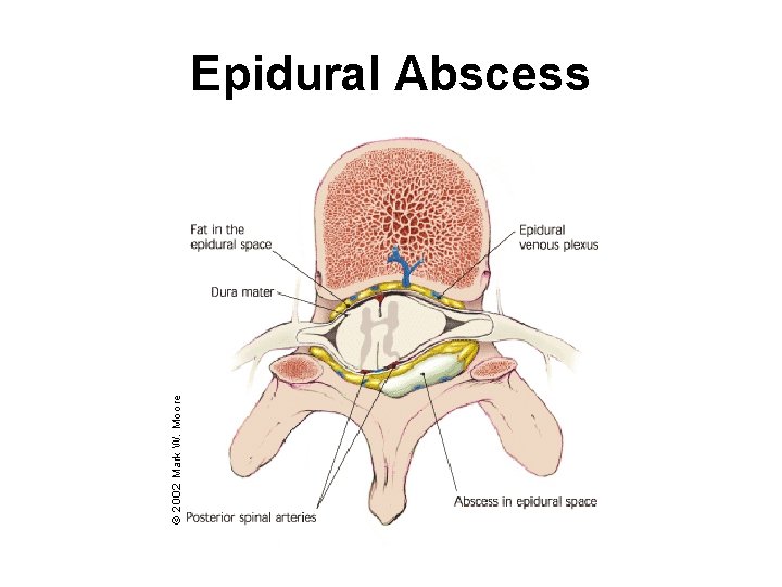 Epidural Abscess 