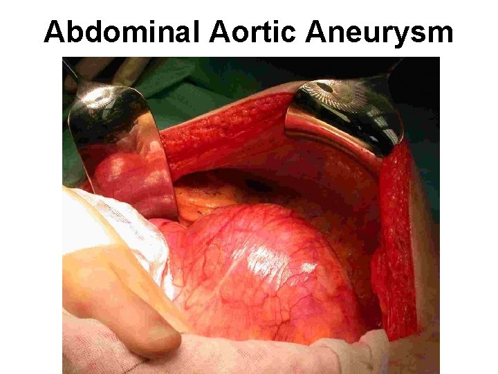 Abdominal Aortic Aneurysm 