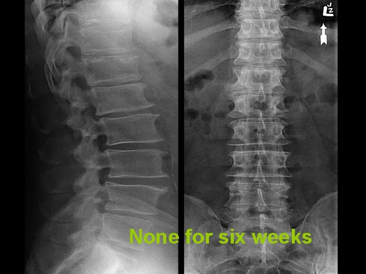 None for six weeks 