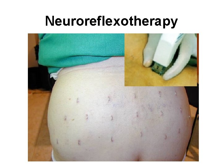 Neuroreflexotherapy 