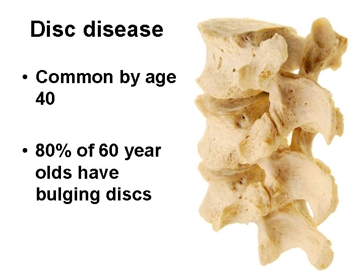Disc disease • Common by age 40 • 80% of 60 year olds have