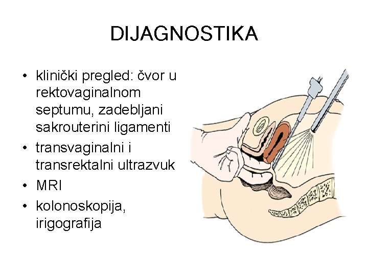 DIJAGNOSTIKA • klinički pregled: čvor u rektovaginalnom septumu, zadebljani sakrouterini ligamenti • transvaginalni i