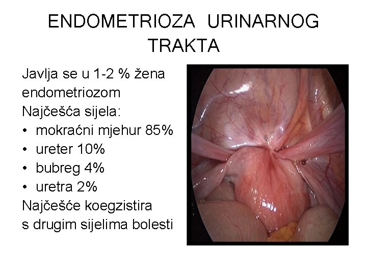 ENDOMETRIOZA URINARNOG TRAKTA Javlja se u 1 -2 % žena endometriozom Najčešća sijela: •