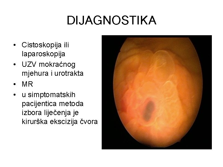 DIJAGNOSTIKA • Cistoskopija ili laparoskopija • UZV mokraćnog mjehura i urotrakta • MR •