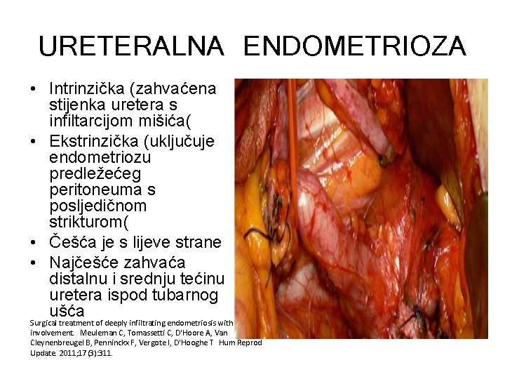 URETERALNA ENDOMETRIOZA • Intrinzička (zahvaćena stijenka uretera s infiltarcijom mišića( • Ekstrinzička (uključuje endometriozu