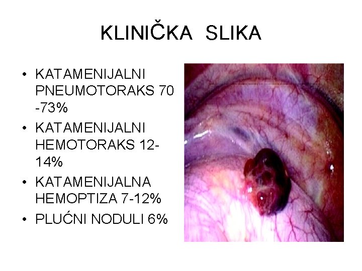 KLINIČKA SLIKA • KATAMENIJALNI PNEUMOTORAKS 70 -73% • KATAMENIJALNI HEMOTORAKS 1214% • KATAMENIJALNA HEMOPTIZA