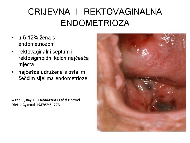 CRIJEVNA I REKTOVAGINALNA ENDOMETRIOZA • u 5 -12% žena s endometriozom • rektovaginalni septum