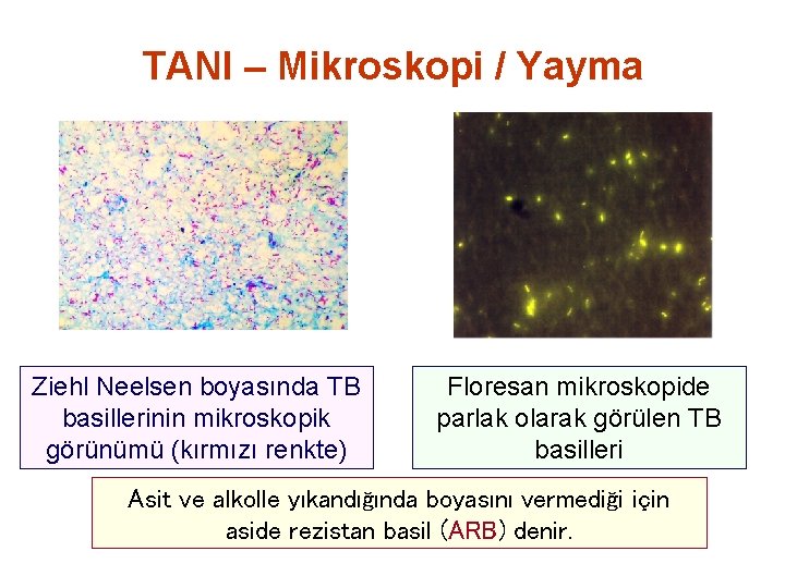 TANI – Mikroskopi / Yayma Ziehl Neelsen boyasında TB basillerinin mikroskopik görünümü (kırmızı renkte)