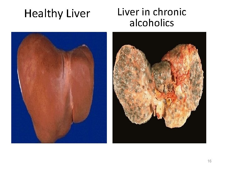 Healthy Liver in chronic alcoholics 16 