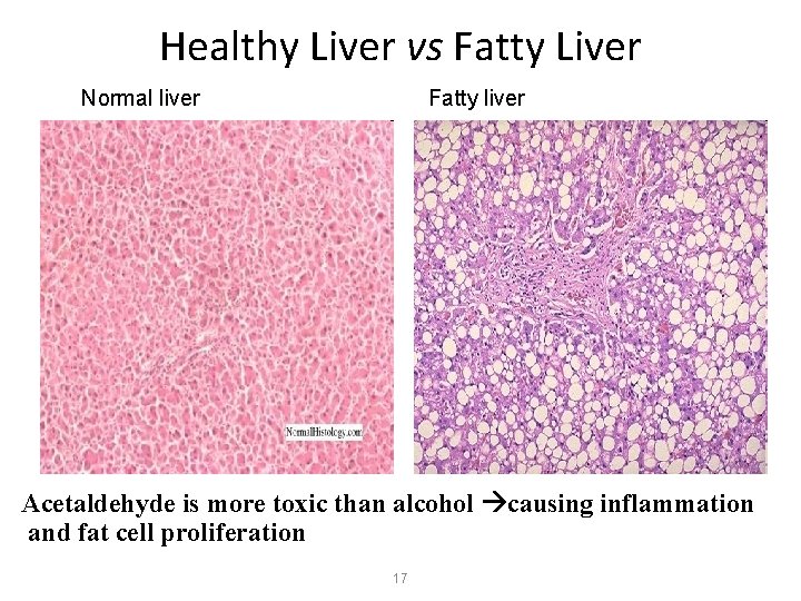 Healthy Liver vs Fatty Liver Normal liver Fatty liver Acetaldehyde is more toxic than