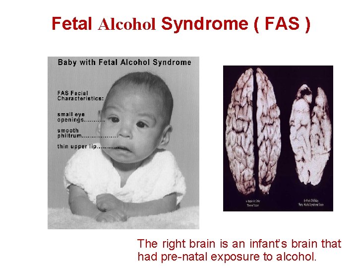 Fetal Alcohol Syndrome ( FAS ) The right brain is an infant’s brain that