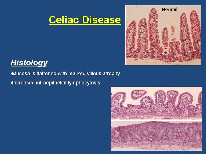 Normal Celiac Disease Histology • Mucosa is flattened with marked villous atrophy. • Increased