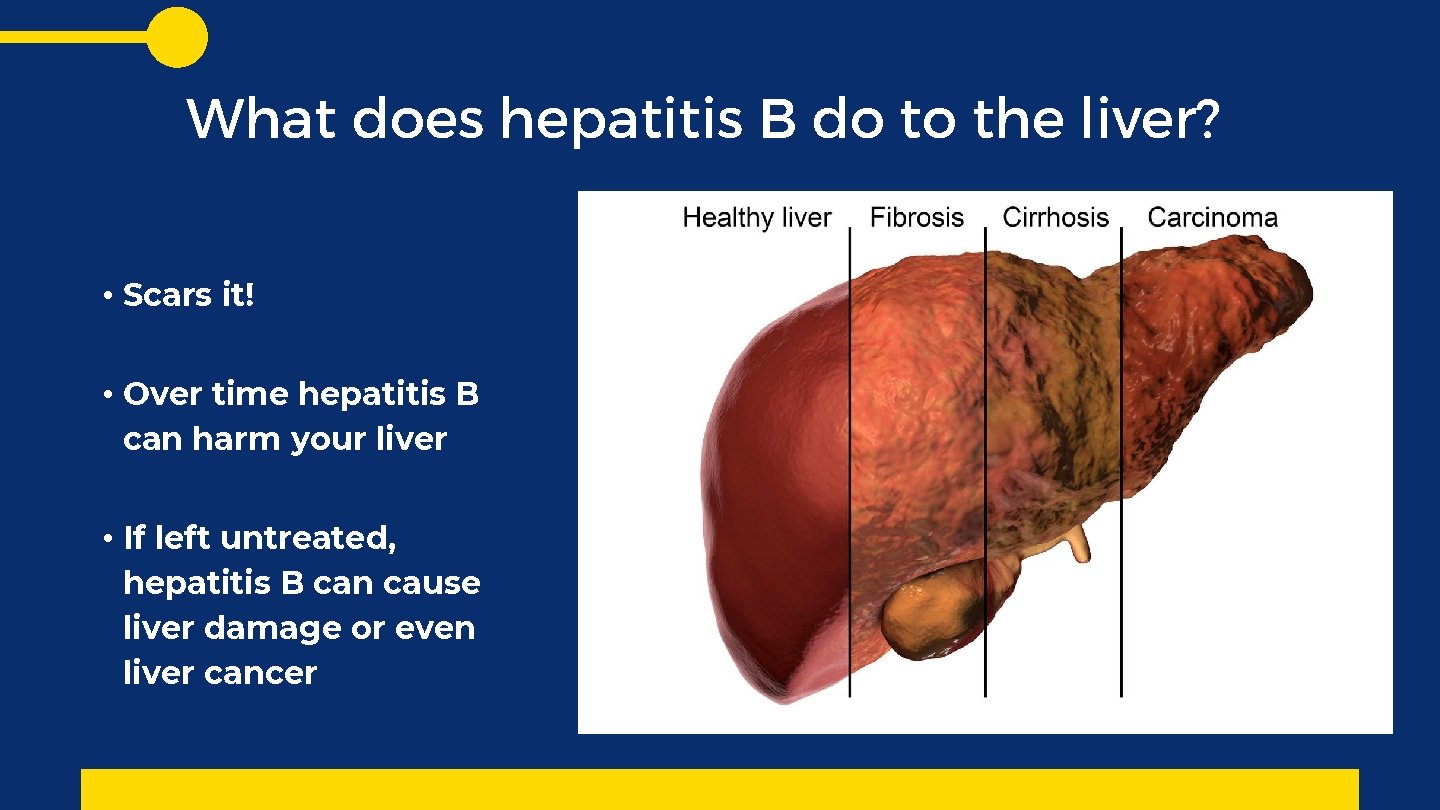 What does hepatitis B do to the liver? • Scars it! • Over time