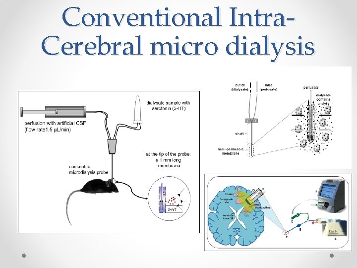 Conventional Intra. Cerebral micro dialysis 