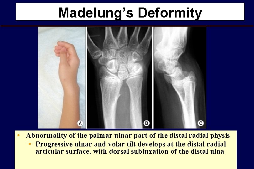 Madelung’s Deformity • Abnormality of the palmar ulnar part of the distal radial physis