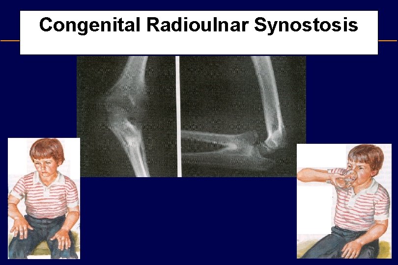 Congenital Radioulnar Synostosis 