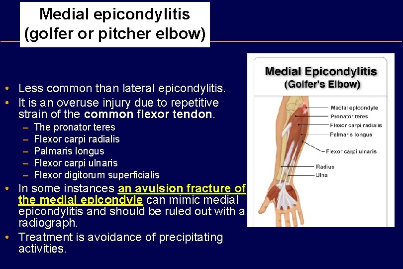 Medial epicondylitis (golfer or pitcher elbow) • Less common than lateral epicondylitis. • It